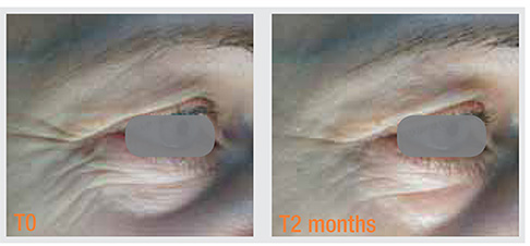 Anti-wrinkle efficacy measurement, second view