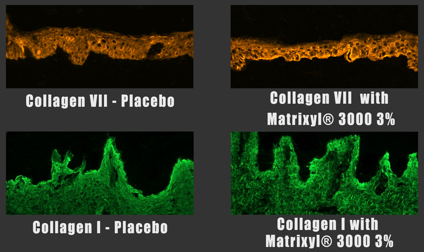 Collagen synthesis at the dermal-epidermal junction